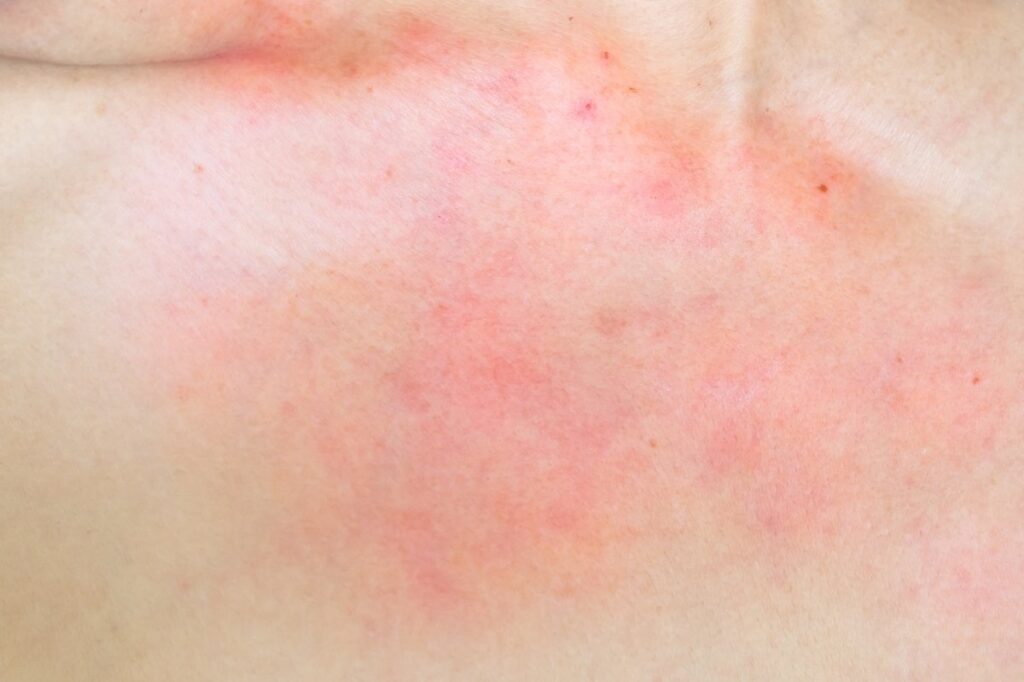 Fragrance in Skincare - Should you be Concerned? 20 An image of a skin with reactions and allergy